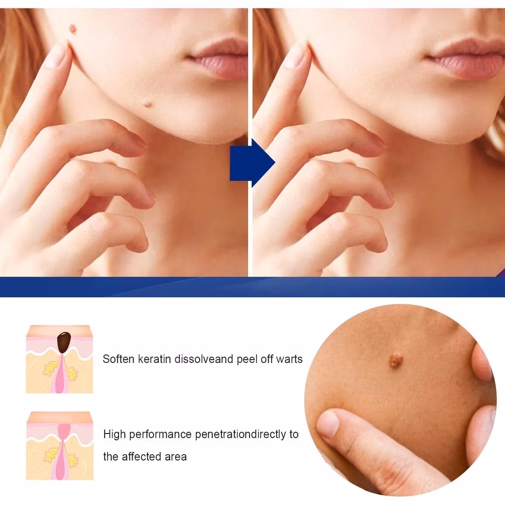 Creme  Remove Verruga